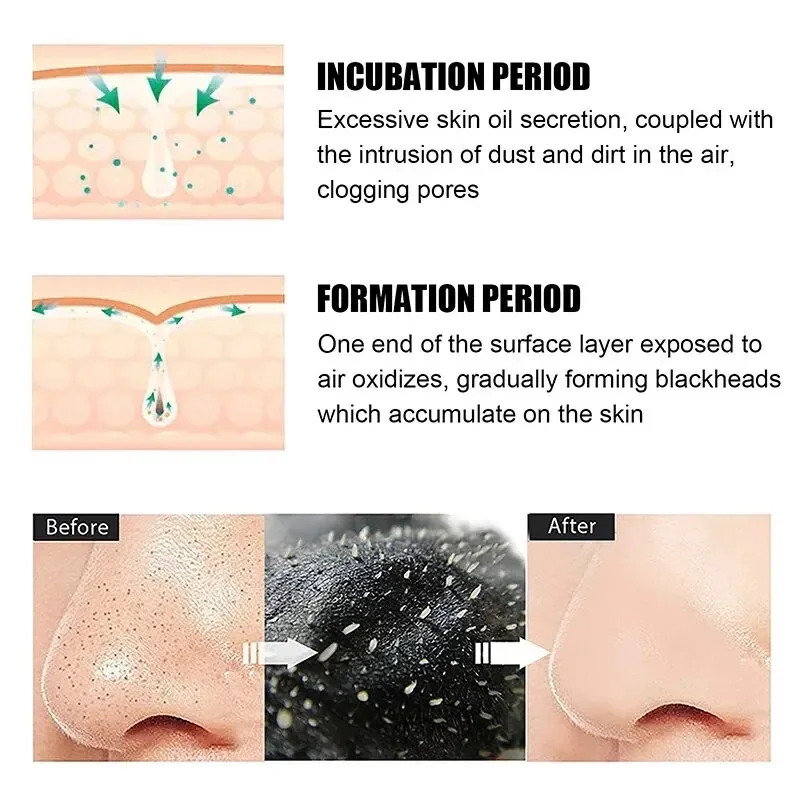 10/150PCS Blackhead Remove Mas - Skincare Indonesia ulasan dan harga